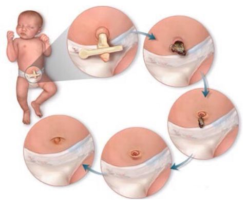 Cordão umbilical - Os cuidados dos primeiros dias - Mamãe & Cia