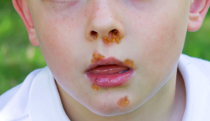 impetigo-imagem