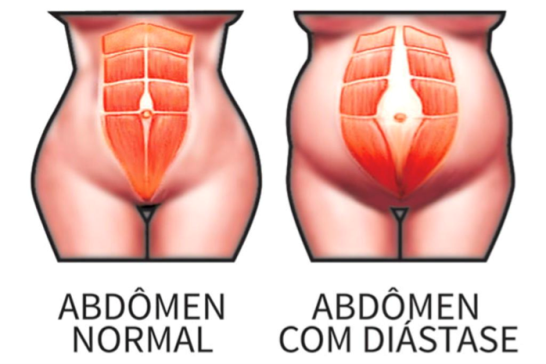 diastase abdominal